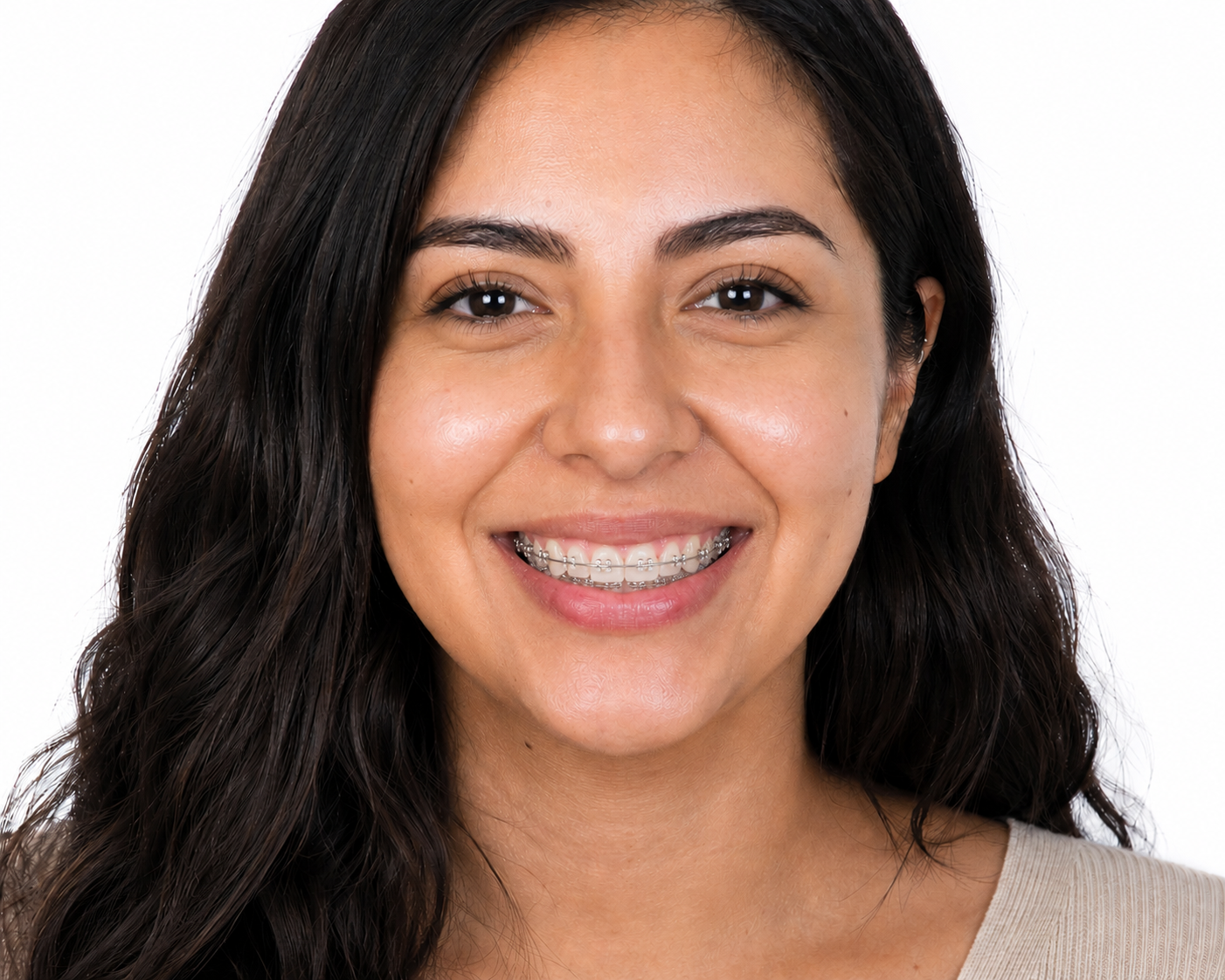 Sonrisa alineada con brackets después del tratamiento de ortodoncia en Salamanca